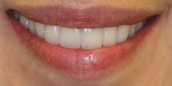 After treatment: two missing front teeth replaced with two dental implants and two veneers
