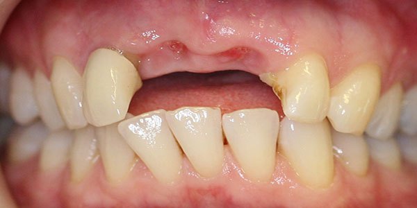 Before treatment: two missing front teeth replaced with two dental implants and two veneers