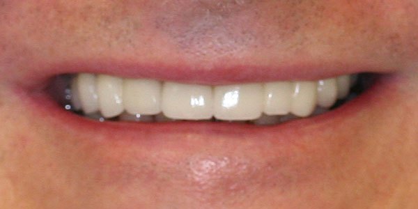 After treatment: worn and failing teeth restored with dental implants and new crowns