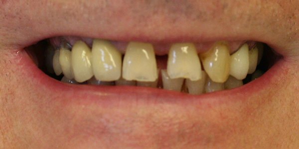 Before treatment: worn and failing teeth restored with dental implants and new crowns