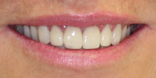 After treatment: crooked, discoloured and worn teeth treated with ten porcelain veneers