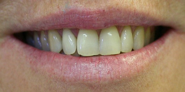 Before treatment: crooked, discoloured and worn teeth treated with ten porcelain veneers