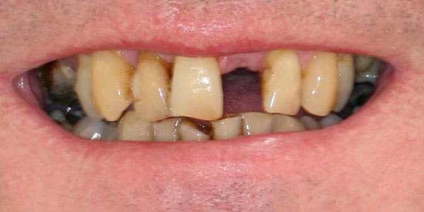 Before treatment: gap and discoloured teeth treated with an implant and crowns