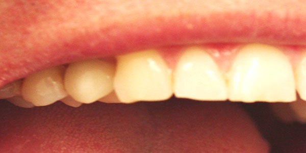 After treatment: gap treated with an implant and a zirconia crown
