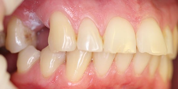 Before treatment: gap treated with an implant and a zirconia crown