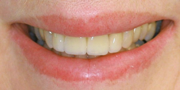 After treatment: small gaps and discoloured front teeth treated with four porcelain veneers