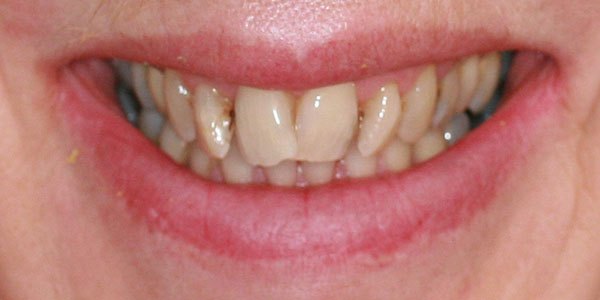 Before treatment: small gaps and discoloured front teeth treated with four porcelain veneers