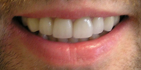 After treatment: discoloured white fillings replaced with eight porcelain veneers