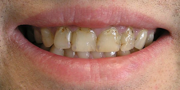 Before treatment: discoloured white fillings replaced with eight porcelain veneers