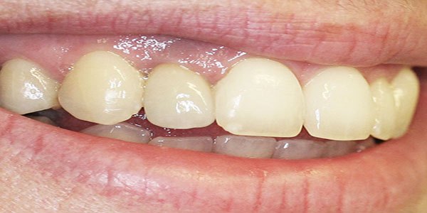 After treatment: failed front crown replaced with a single implant and ceramic crown