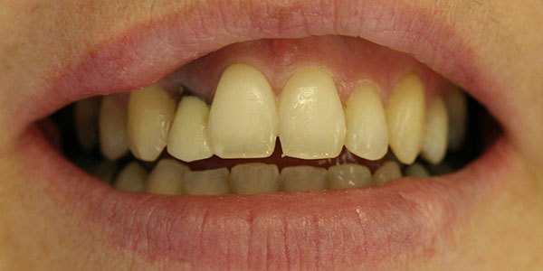 Before treatment: failed front crown replaced with a single implant and ceramic crown