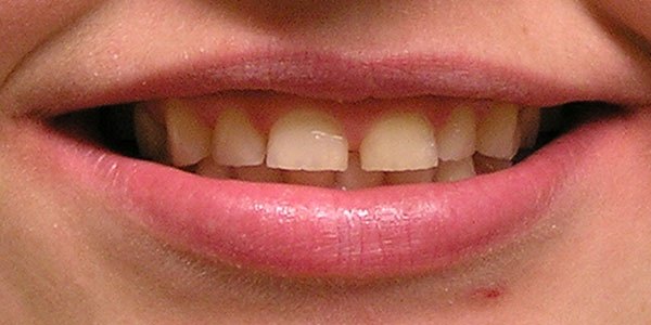 Before treatment: large gap and worn front teeth restored with veneers