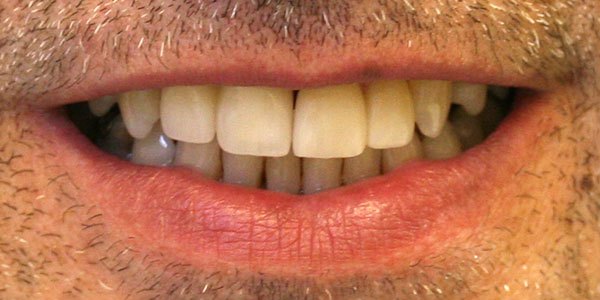 After treatment: front gap and two missing teeth treated with two implants and two veneers