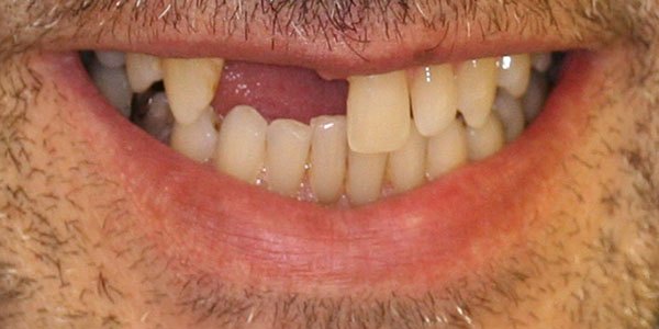 Before treatment: front gap and two missing teeth treated with two implants and two veneers