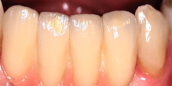 After treatment: two missing lower front teeth replaced with a four-tooth implant bridge