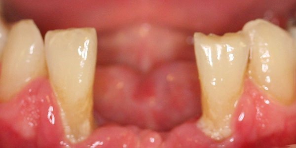 Before treatment: two missing lower front teeth replaced with a four-tooth implant bridge