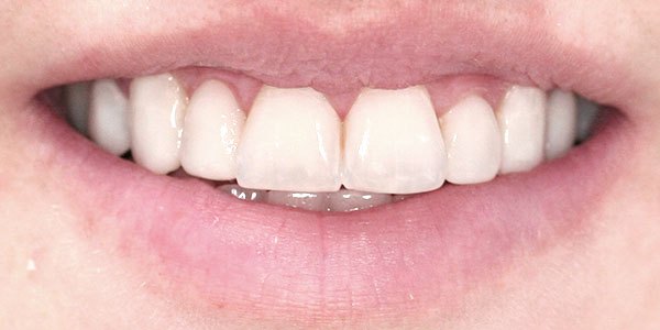 After treatment: ten veneers for a more natural smile