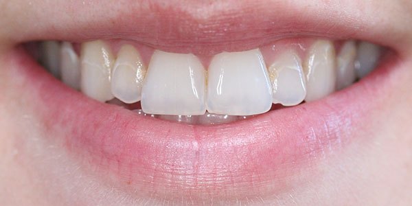 Before treatment: ten veneers for a more natural smile
