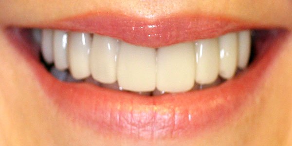 After treatment: ten veneers for a more natural smile
