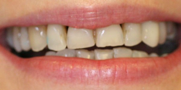 Before treatment: ten veneers for a more natural smile