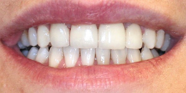 After treatment: four veneers and teeth whitening