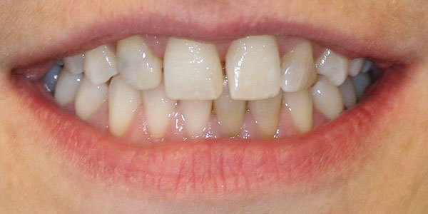 Before treatment: four veneers and teeth whitening