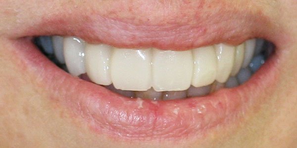 After treatment: high-quality temporary crowns during treatment