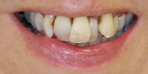 Before treatment: high-quality temporary crowns during treatment