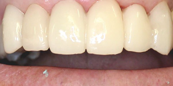 After treatment: high-quality temporary crowns during treatment