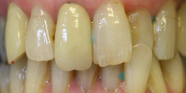 Before treatment: high-quality temporary crowns during treatment