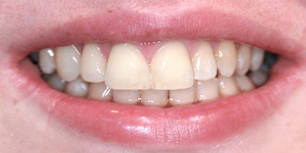 After treatment: gap closed with composite bonding in one appointment