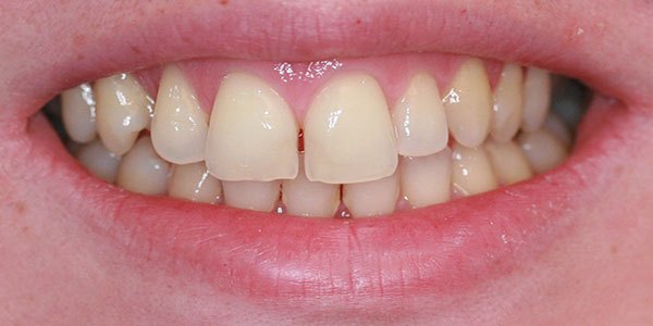 Before treatment: gap closed with composite bonding in one appointment