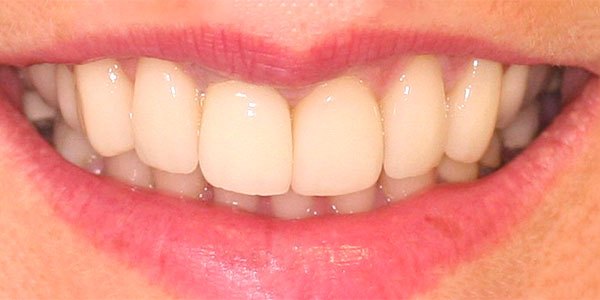 After treatment: six porcelain veneers