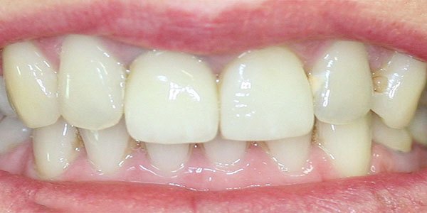 Before treatment: six porcelain veneers