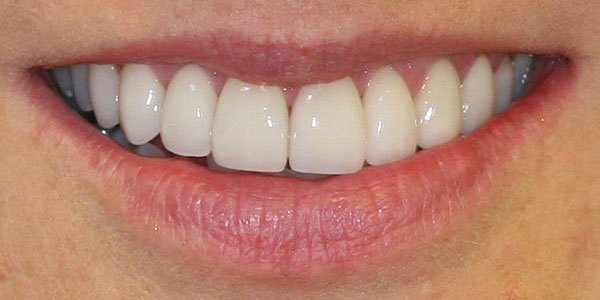 After treatment: six porcelain veneers