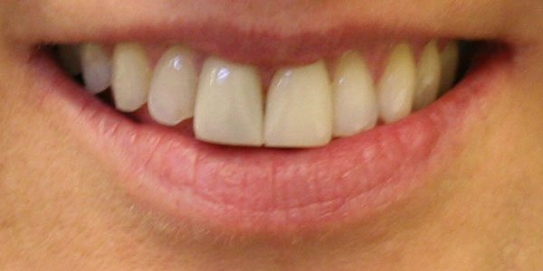 Before treatment: six porcelain veneers