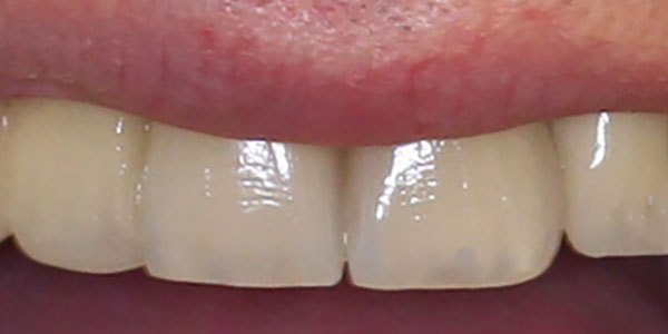 After treatment: two upper implants with matching implant crowns