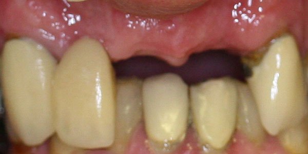 Before treatment: two upper implants with matching implant crowns