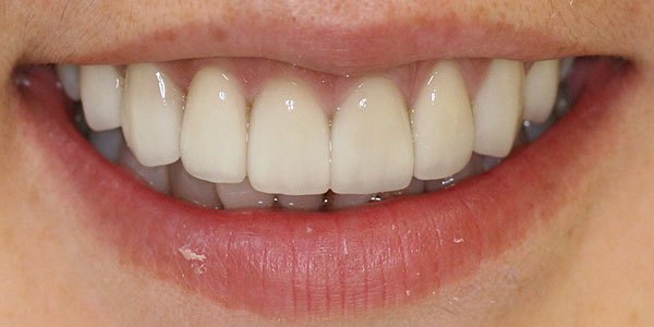 After treatment: eight porcelain veneers