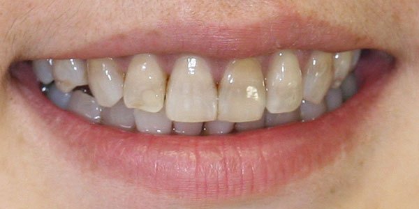 Before treatment: eight porcelain veneers