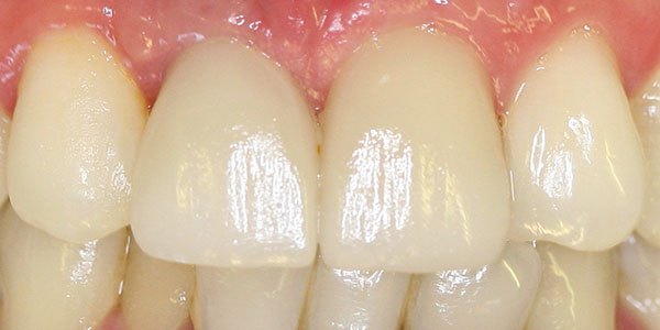 After treatment: two porcelain veneers