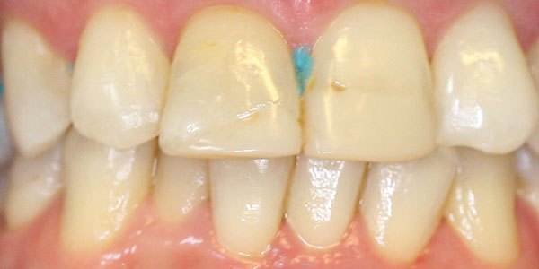 Before treatment: two porcelain veneers