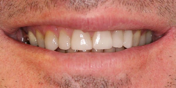 After treatment: six front teeth built up with composite bonding