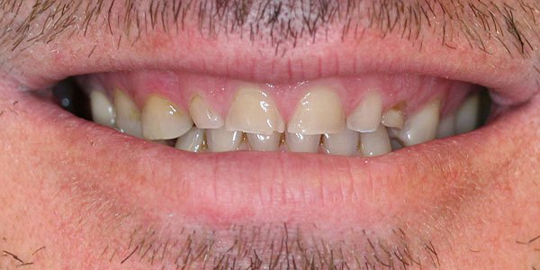 Before treatment: six front teeth built up with composite bonding