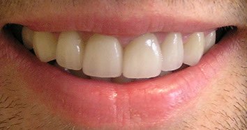 After treatment: front teeth damaged by erosion restored with eight porcelain veneers