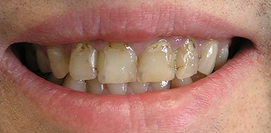 Before treatment: front teeth damaged by erosion restored with eight porcelain veneers