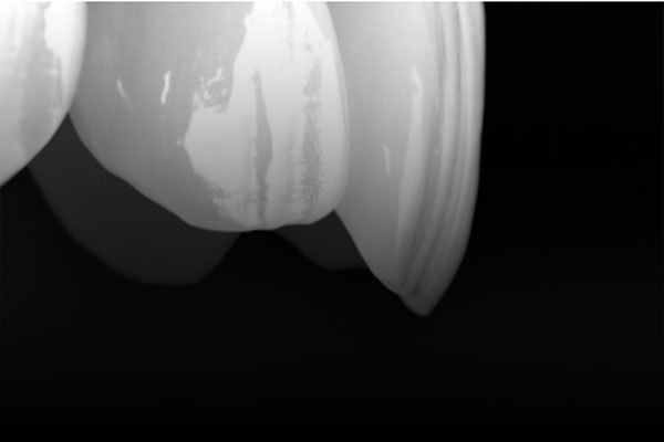Porcelain veneers